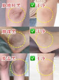 Kobayashi Elbow & Knee EX Melanin Peeling Cream 15g